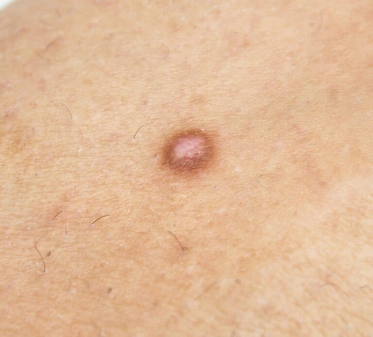 Dermatofibrome