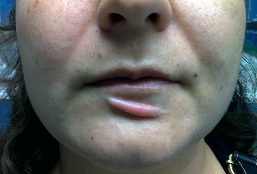 Hypertrophe Narben