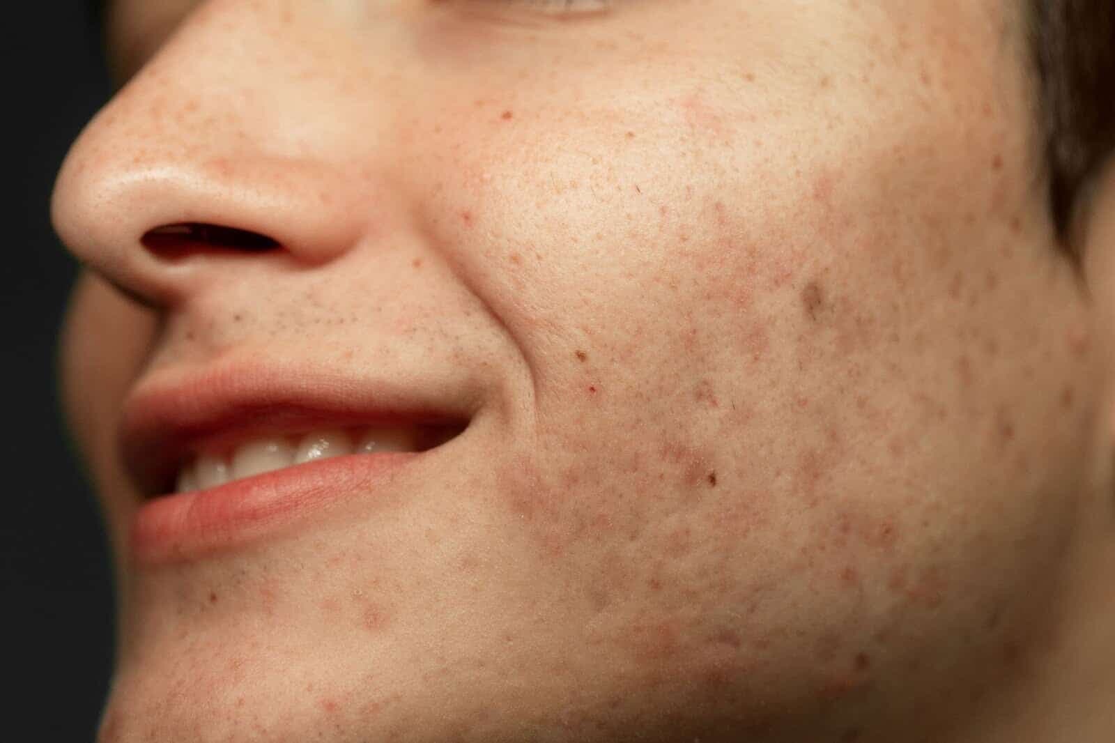 PIH